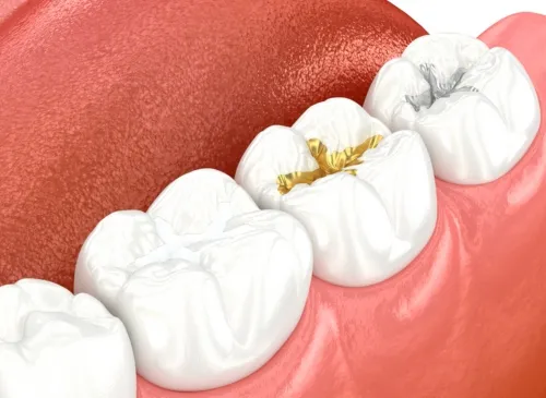 Dental Filling Procedure